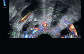 Dilatations veineuses pelviennes