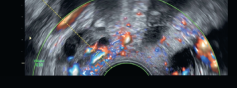 Dilatations veineuses pelviennes