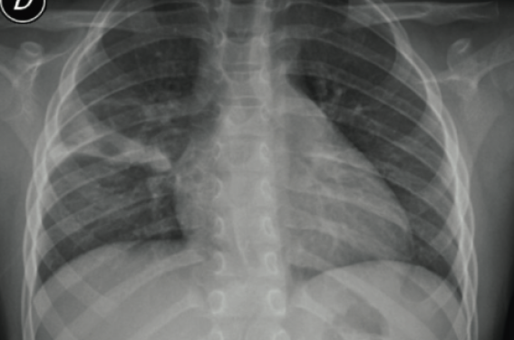Opacité persistante sur la radiographie thoracique : à quoi penser ?